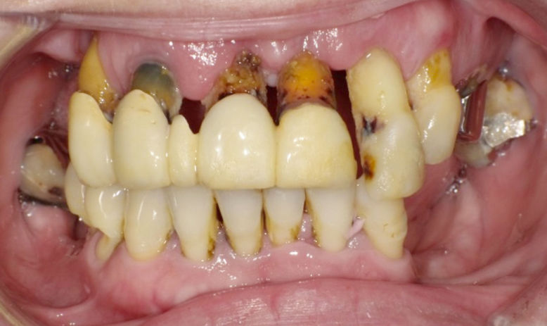 治療前：歯は残っていますが噛みづらい状態