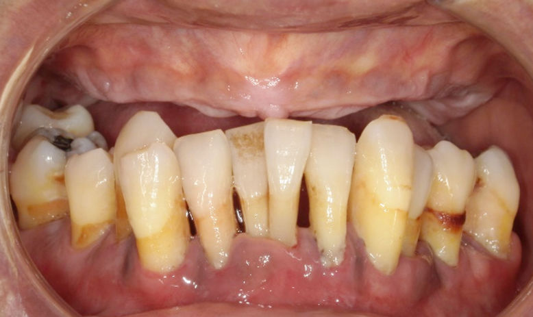 治療前：上顎に歯は無く、下顎は歯は残っていますが噛みづらい状態