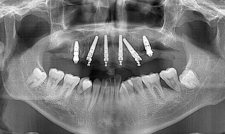 オールオン4症例レントゲン写真
