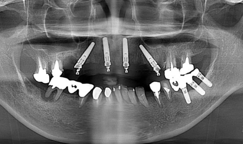All-on-4症例レントゲン写真