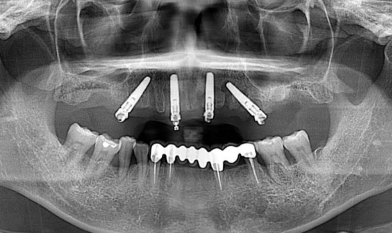 オールオンフォー症例レントゲン写真