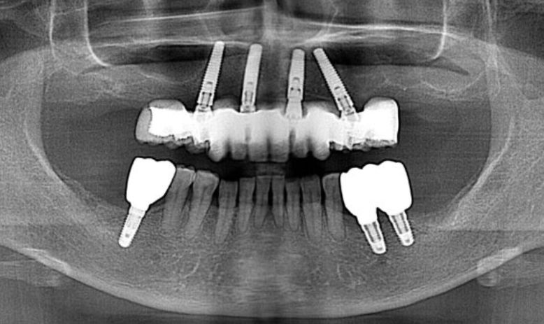 オールオン4レントゲン写真