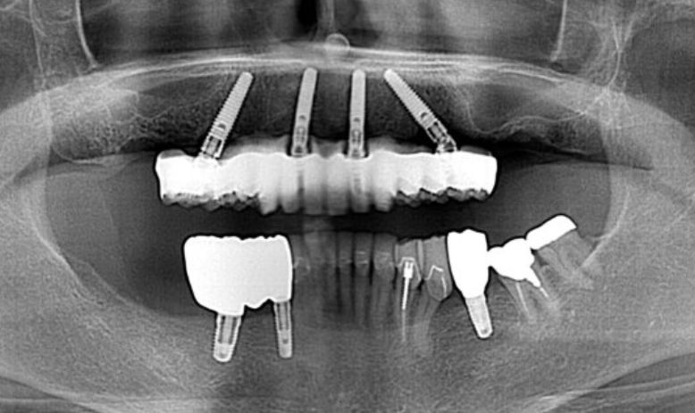 All-on-4レントゲン写真